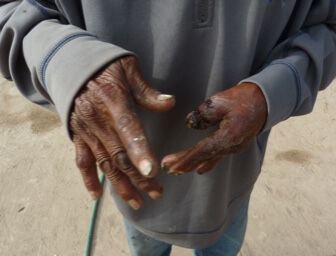 Habitantes de La Laguna ya muestran muerte de tejidos por el consumo prolongado de arsénico.